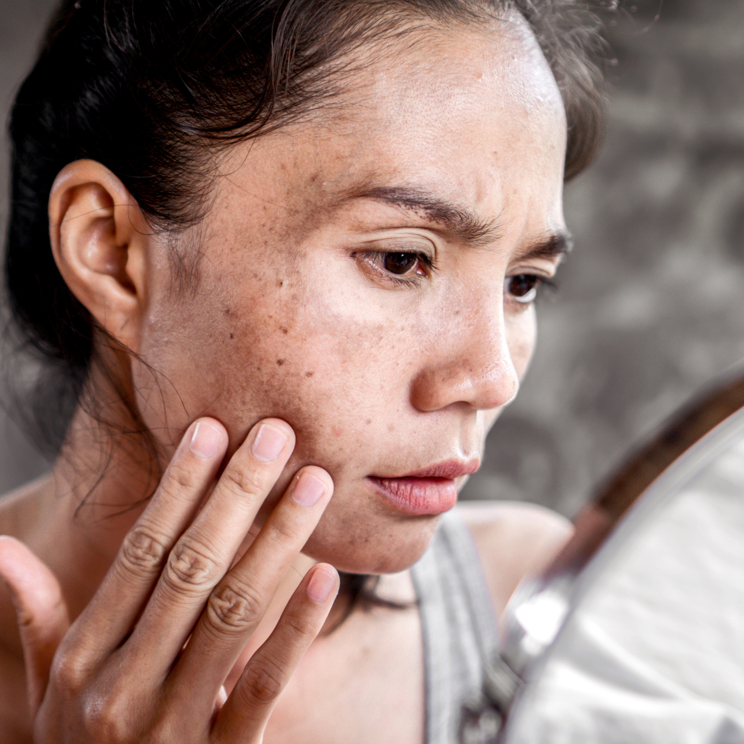Melasma: por que não tem “cura” e o que realmente ajuda